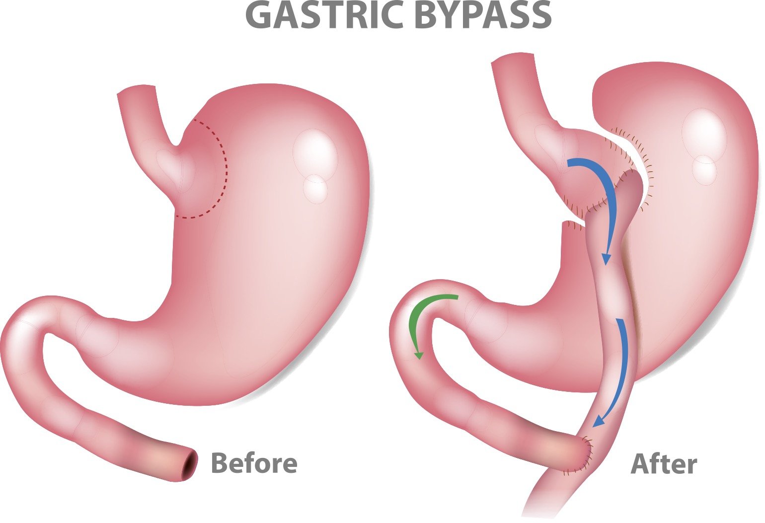 Gastric Bypass